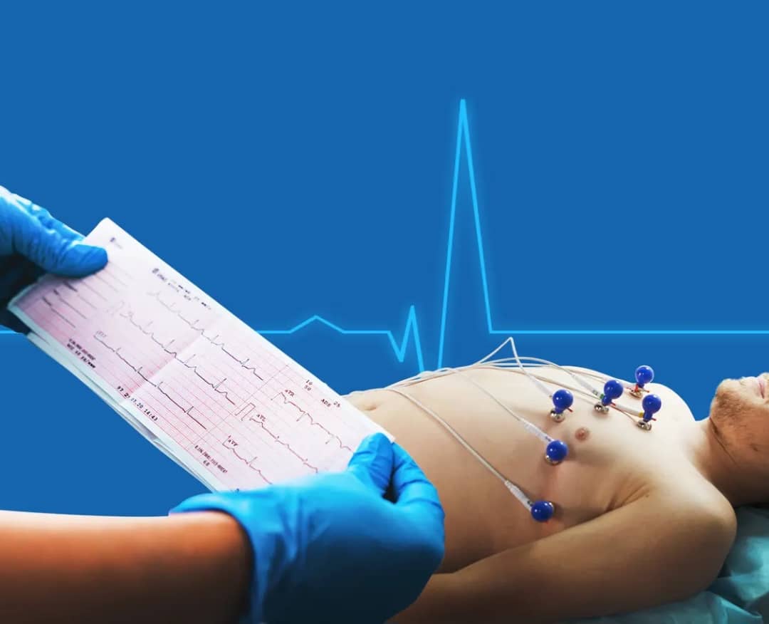 ECG